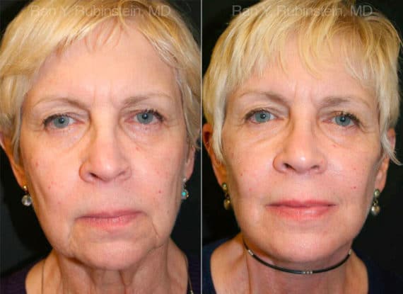 Face lift & Neck lift Before and After Photos in Newburgh, NY, Patient 12653