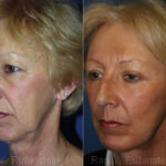 Face lift & Neck lift Before and After Photos in Newburgh, NY, Patient 12658