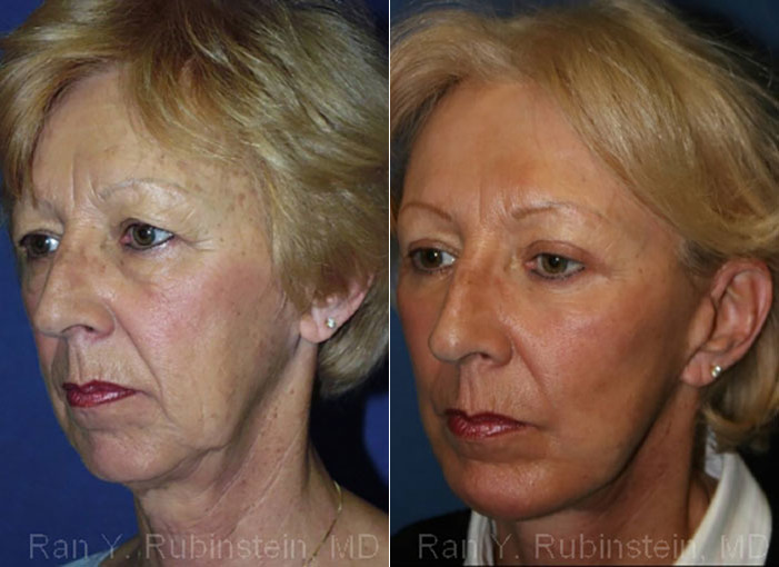 Face lift & Neck lift Before and After Photos in Newburgh, NY, Patient 12658