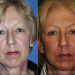 Face lift & Neck lift Before and After Photos in Newburgh, NY, Patient 12658