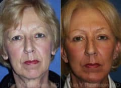 Face lift & Neck lift Before and After Photos in Newburgh, NY, Patient 12658