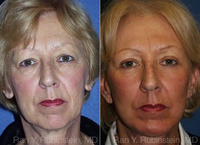 Face lift & Neck lift Before and After Photos in Newburgh, NY, Patient 12658