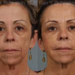 Dermal Fillers Before and After Photos in Newburgh, NY, Patient 12736