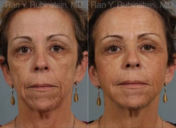 Dermal Fillers Before and After Photos in Newburgh, NY, Patient 12736