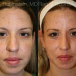 Laser Treatments Before and After Photos in Newburgh, NY, Patient 12830