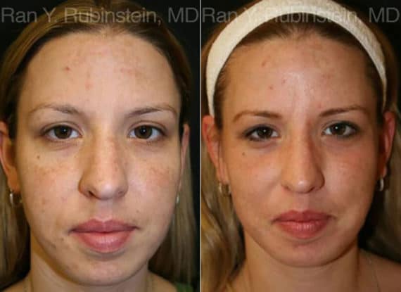 Laser Treatments Before and After Photos in Newburgh, NY, Patient 12830