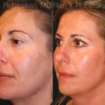 Laser Treatments Before and After Photos in Newburgh, NY, Patient 12833