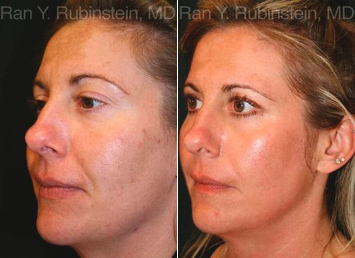 Laser Treatments Before and After Photos in Newburgh, NY, Patient 12833