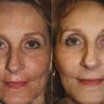 Peels & Microdermabrasion Before and After Photos in Newburgh, NY, Patient 12969