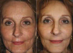 Peels & Microdermabrasion Before and After Photos in Newburgh, NY, Patient 12969