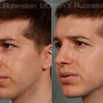 Rhinoplasty Before and After Photos in Newburgh, NY, Patient 13079