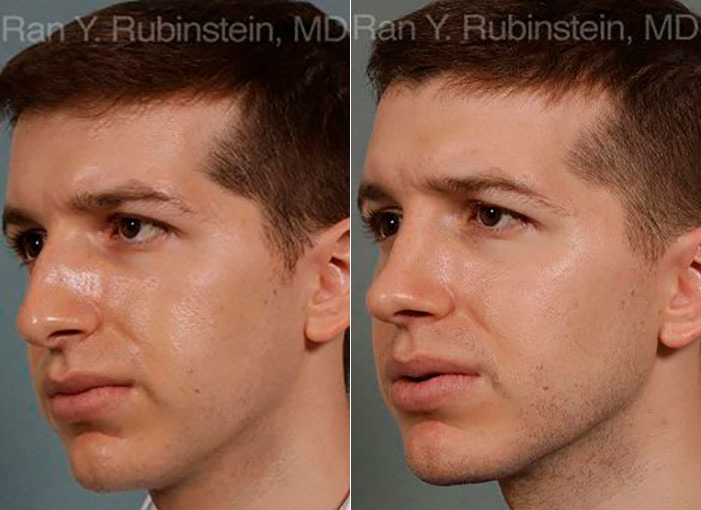 Rhinoplasty Before and After Photos in Newburgh, NY, Patient 13079