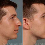 Rhinoplasty Before and After Photos in Newburgh, NY, Patient 13079