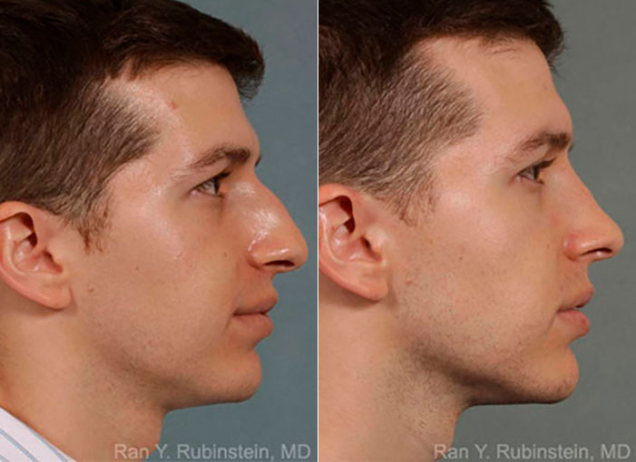 Rhinoplasty Before and After Photos in Newburgh, NY, Patient 13079