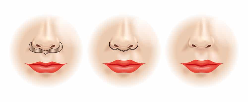 A strip of skin is removed just beneath the nose in the shape of a bullhorn. The small incision is hidden in the crease of the nose. Lip Lift in Newburgh, NY