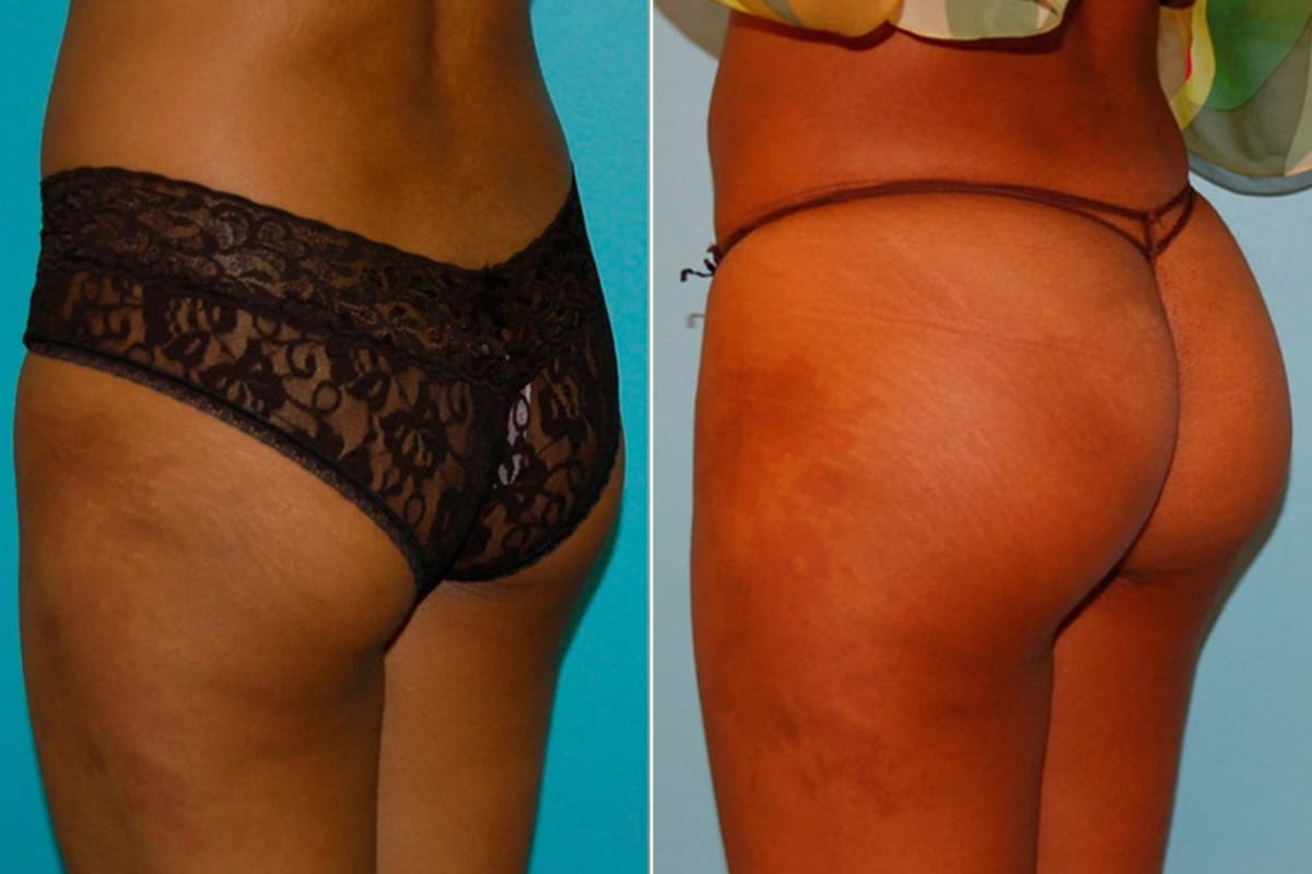 Pin on Brazilian buttlift surgery