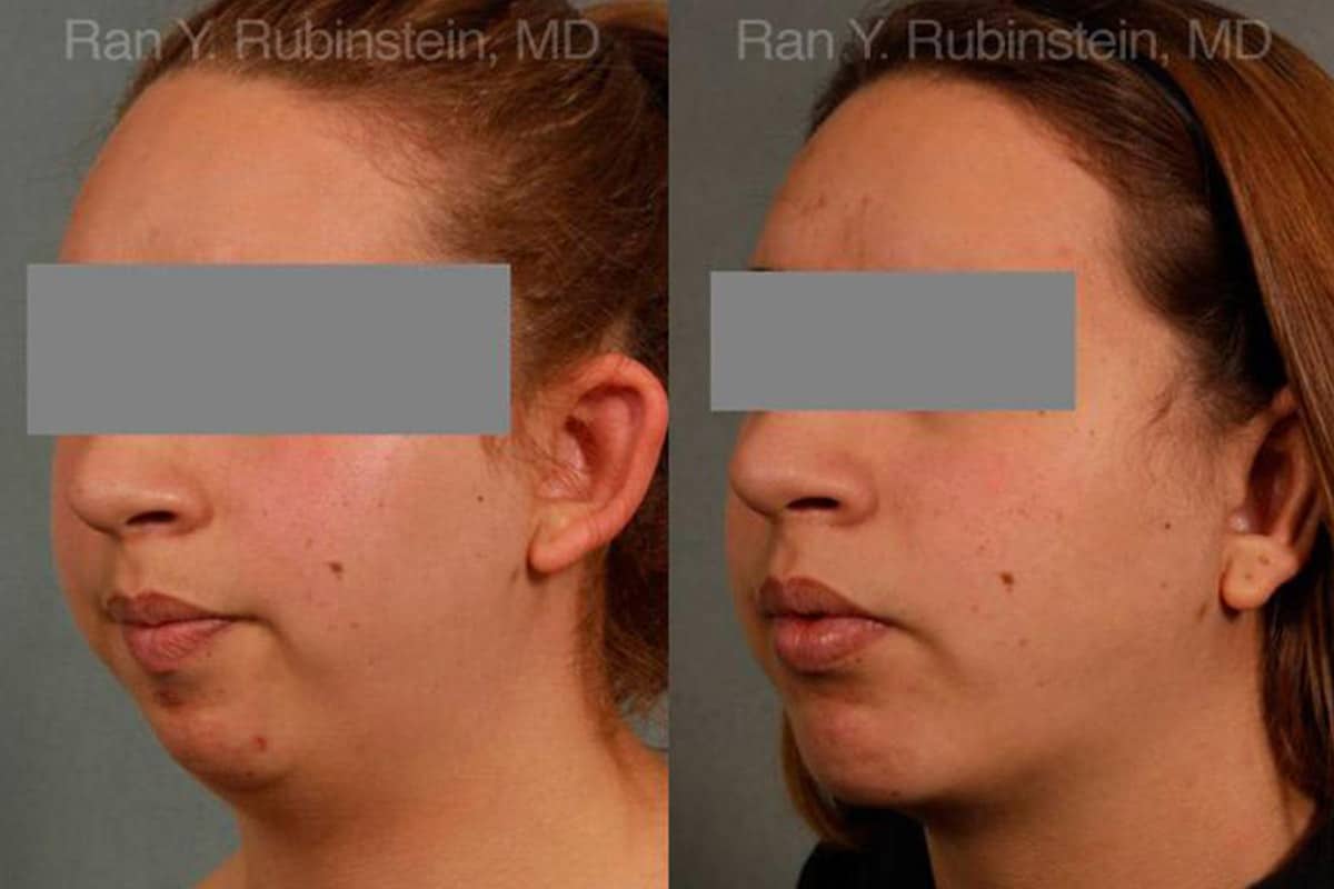 Chin Augmentation New York Facial Plastic Surgeon DrJoshua Zimm -  Manhattan Chin Implant
