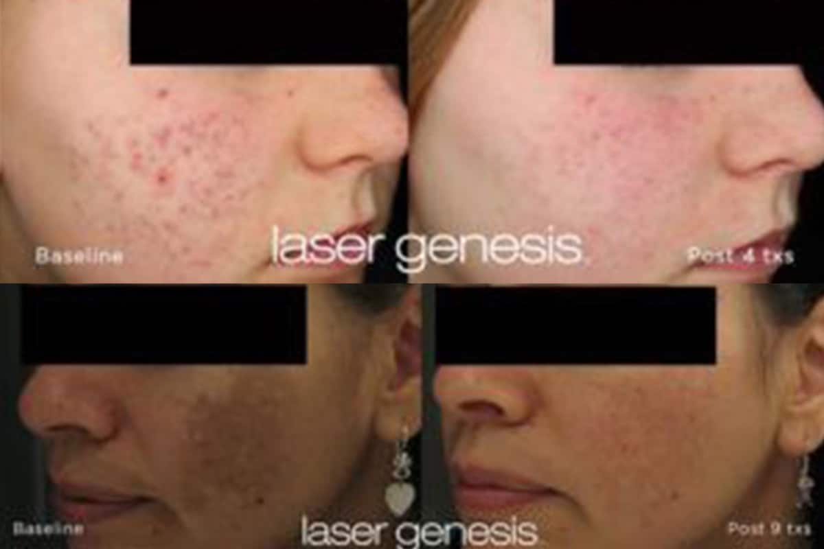 Get Radiant Skin: Laser Genesis for Age-Defying Beauty and Reduced Redness