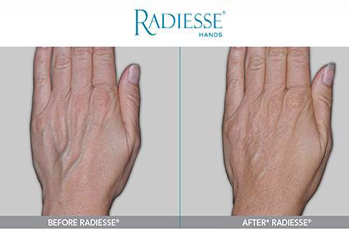 Hand Rejuvenation Hudson Valley, NY