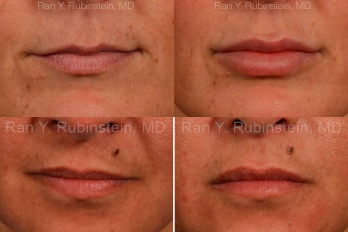 Transform Your Smile with Restylane Silk’s Lip Enhancements