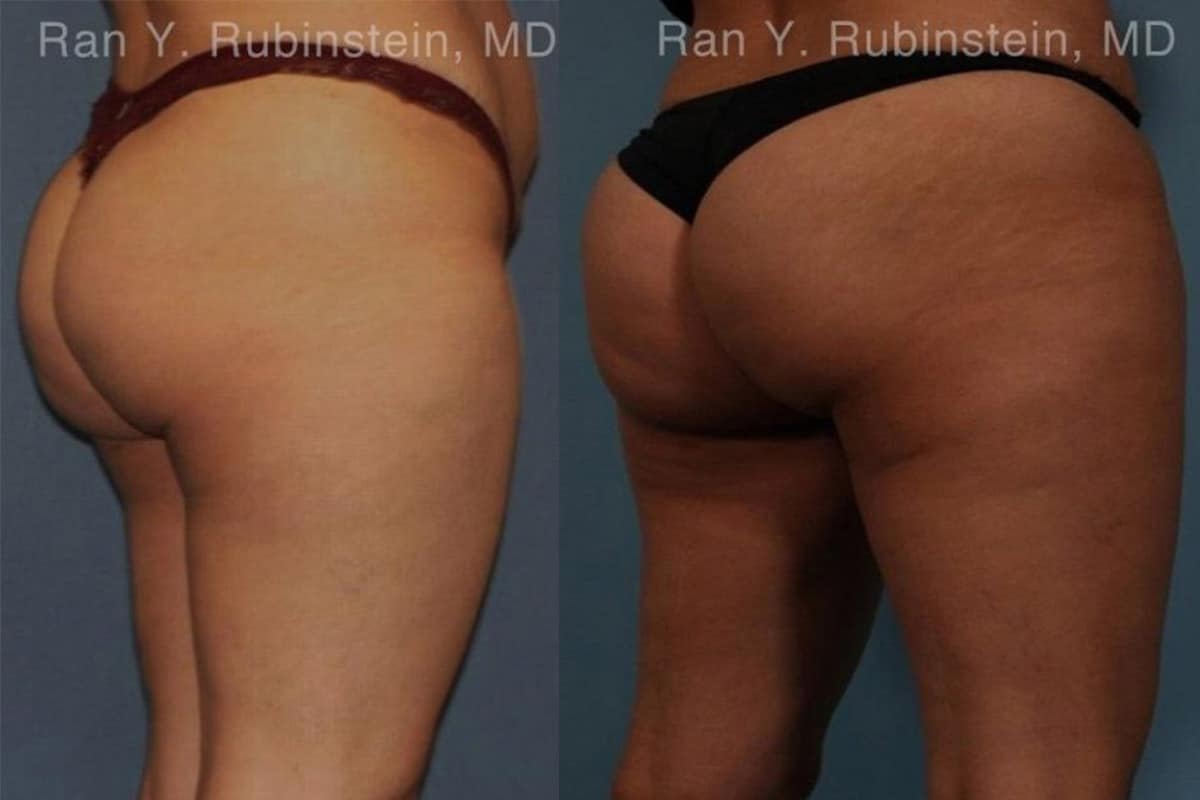 NON-SURGICAL BUTT-LIFT WITH SCULPTRA AND RADIESSE, Before & After