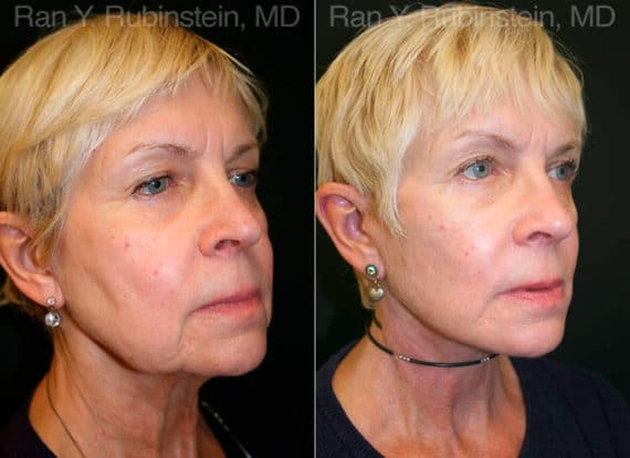 Face lift & Neck lift Before and After Photos in Newburgh, NY, Patient 12653