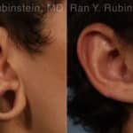 Earlobe Repair Before and After Photos in Newburgh, NY, Patient 19161