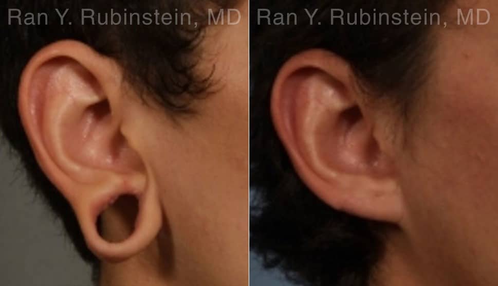 Earlobe Repair Before and After Photos in Newburgh, NY, Patient 19161