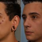 Earlobe Repair Before and After Photos in Newburgh, NY, Patient 19161