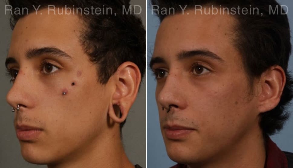 Earlobe Repair Before and After Photos in Montvale, NJ, Patient 19161