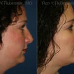 Smart Lipo Neck Before and After Photos in Newburgh, NY, Patient 13283