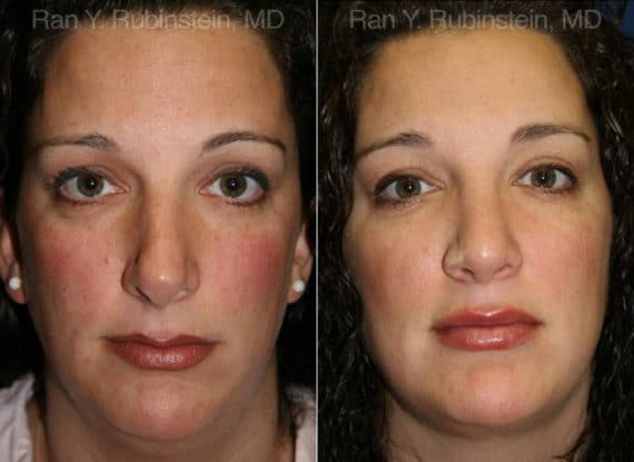 Smart Lipo Neck Before and After Photos in Newburgh, NY, Patient 13283