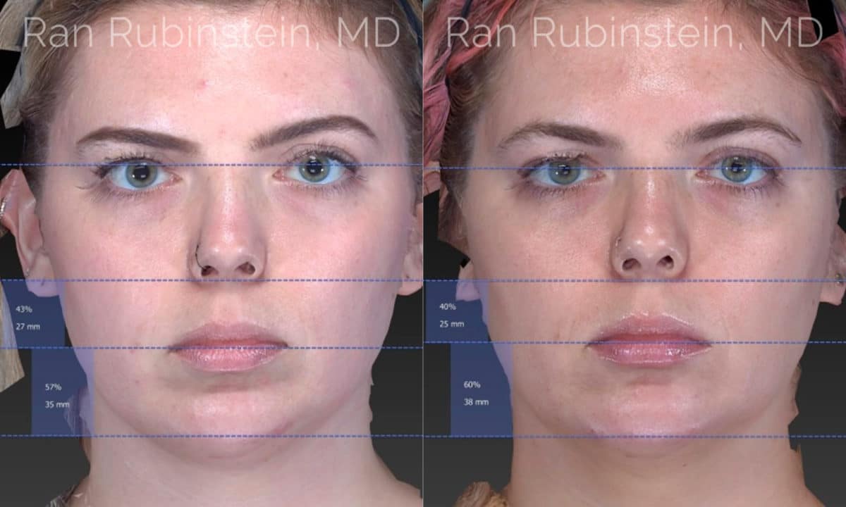 Chin Filler Before and After Photos in Newburgh, NY, Patient 20118