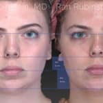 Chin Filler Before and After Photos in Montvale, NJ, Patient 20118