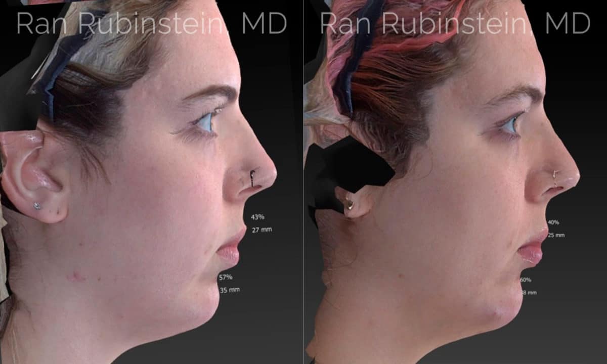 Chin Filler Before and After Photos in Newburgh, NY, Patient 20118