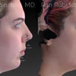 Chin Filler Before and After Photos in Newburgh, NY, Patient 20118