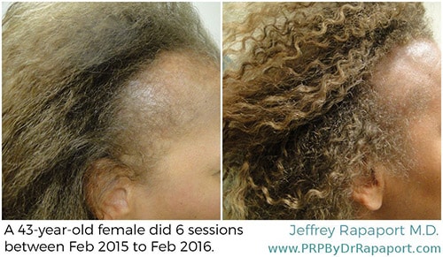 Hair restoration before & after photos 4