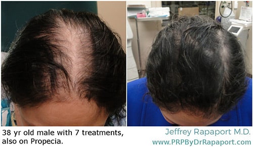 Hair restoration before & after photos 5