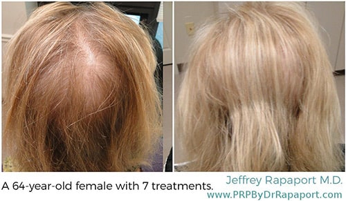 Hair restoration before & after photos 6