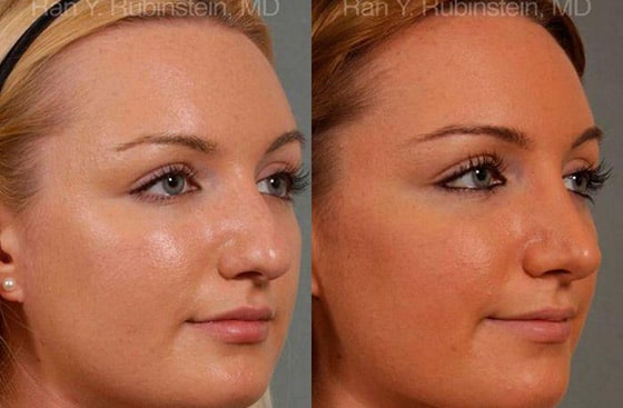 Rhinoplasty with Injectable Fillers - Newburgh - NY