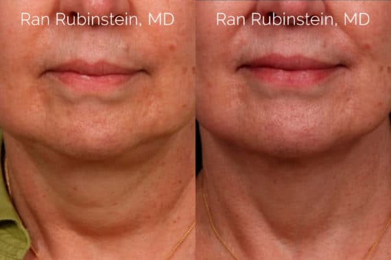 Laser Lift Precision Tx Before and After Photos in Newburgh, NY, Patient 20459