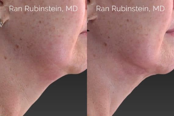 Laser Lift Precision Tx Before and After Photos in Newburgh, NY, Patient 20459