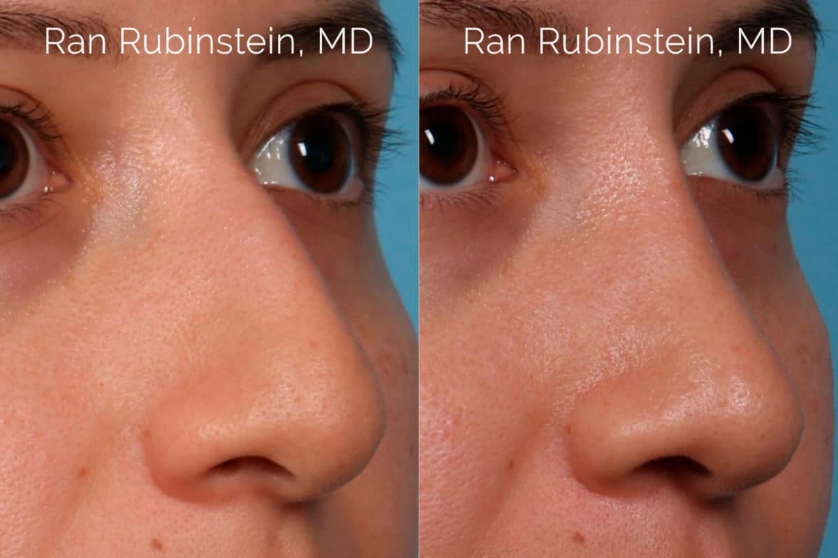 Ethnic Rhinoplasty Before and After Photos in Newburgh, NY, Patient 20466