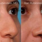 Ethnic Rhinoplasty Before and After Photos in Newburgh, NY, Patient 20466