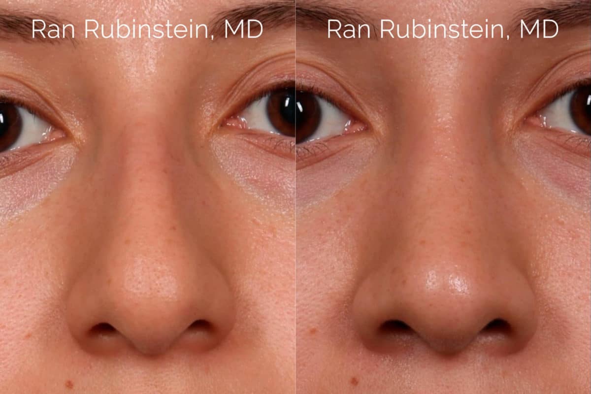 Ethnic Rhinoplasty Before and After Photos in Newburgh, NY, Patient 20466