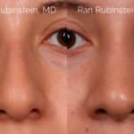 Ethnic Rhinoplasty Before and After Photos in Montvale, NJ, Patient 20466