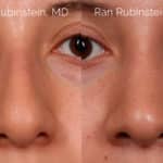 Ethnic Rhinoplasty Before and After Photos in Newburgh, NY, Patient 20466