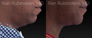 Chin Filler Before and After Photos in Newburgh, NY, Patient 20743