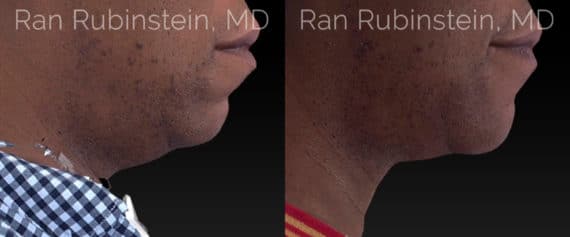 Chin Filler Before and After Photos in Newburgh, NY, Patient 20743