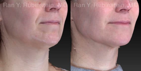 Chin Filler Before and After Photos in Newburgh, NY, Patient 21103